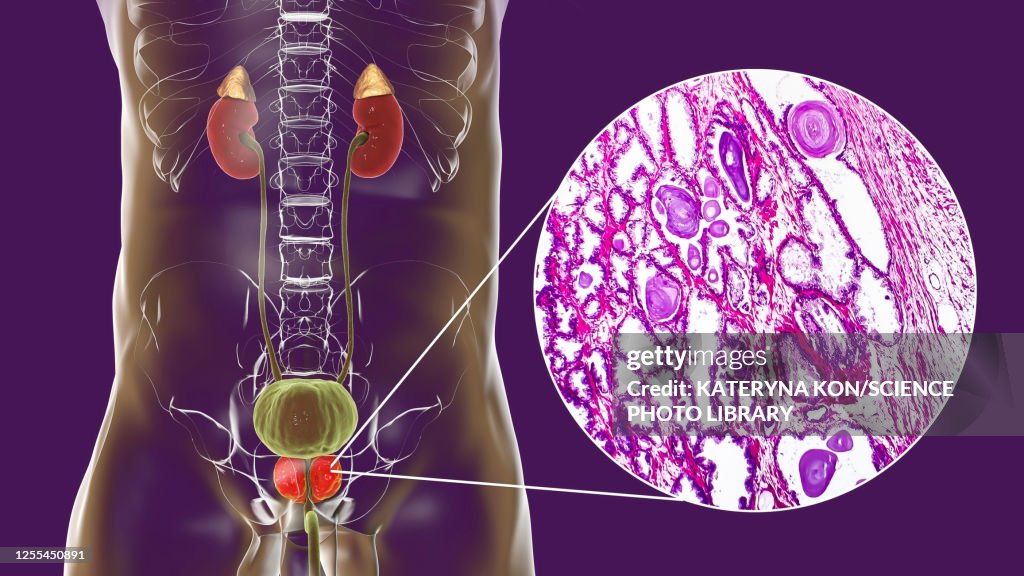Benign prostatic hyperplasia, illustration and micrograph