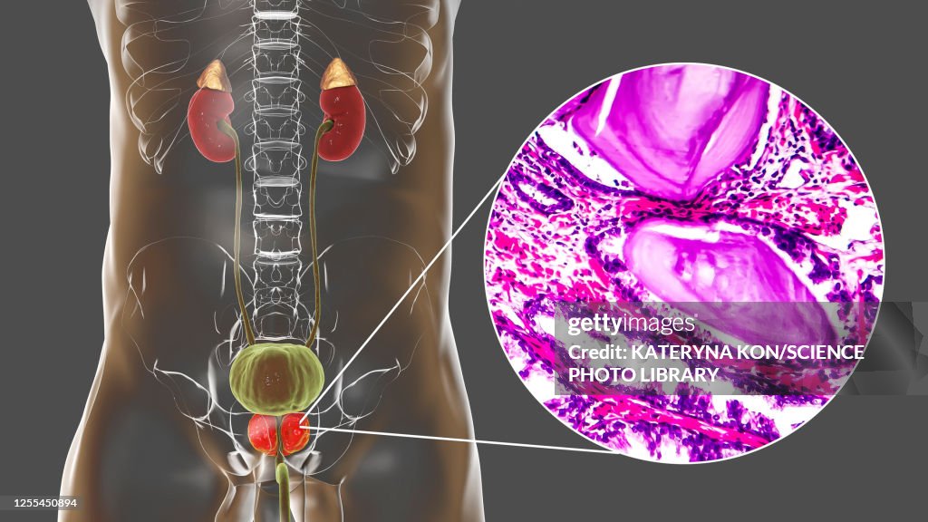 Benign prostatic hyperplasia, illustration and micrograph