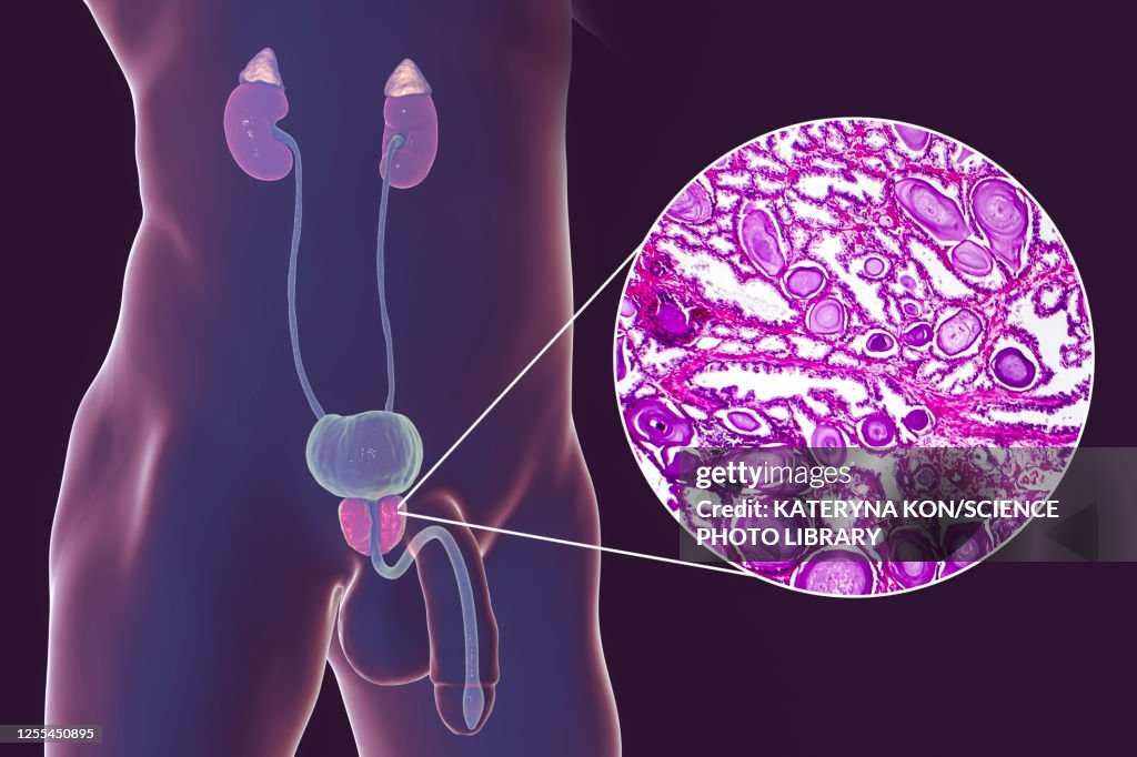 Benign prostatic hyperplasia, illustration and micrograph