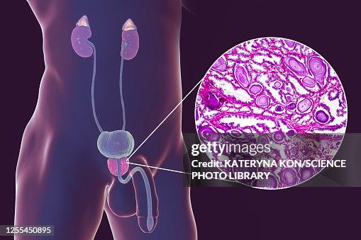 Benign prostatic hyperplasia, illustration and micrograph Benign prostatic hyperplasia, illustration and micrograph