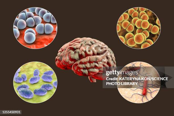 causes of bacterial meningitis, illustration - meningococcal stock illustrations