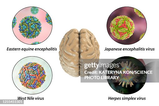 Creier Infectat Brain Infections Illustration High-Res Vector Graphic - Getty Images