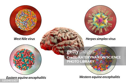 Brain Infections Illustration High-Res Vector Graphic - Getty Images