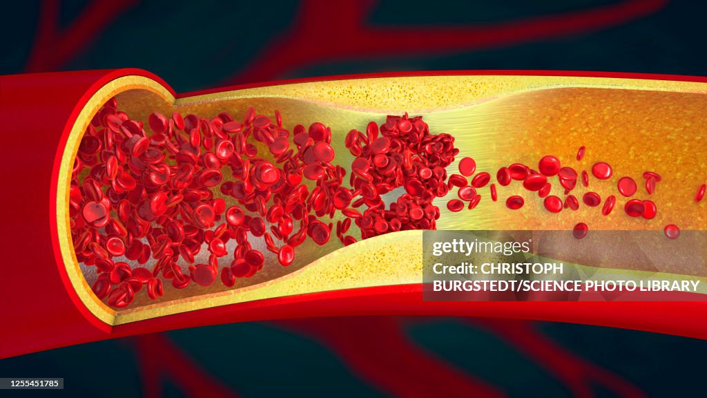 Blood clot, illustration