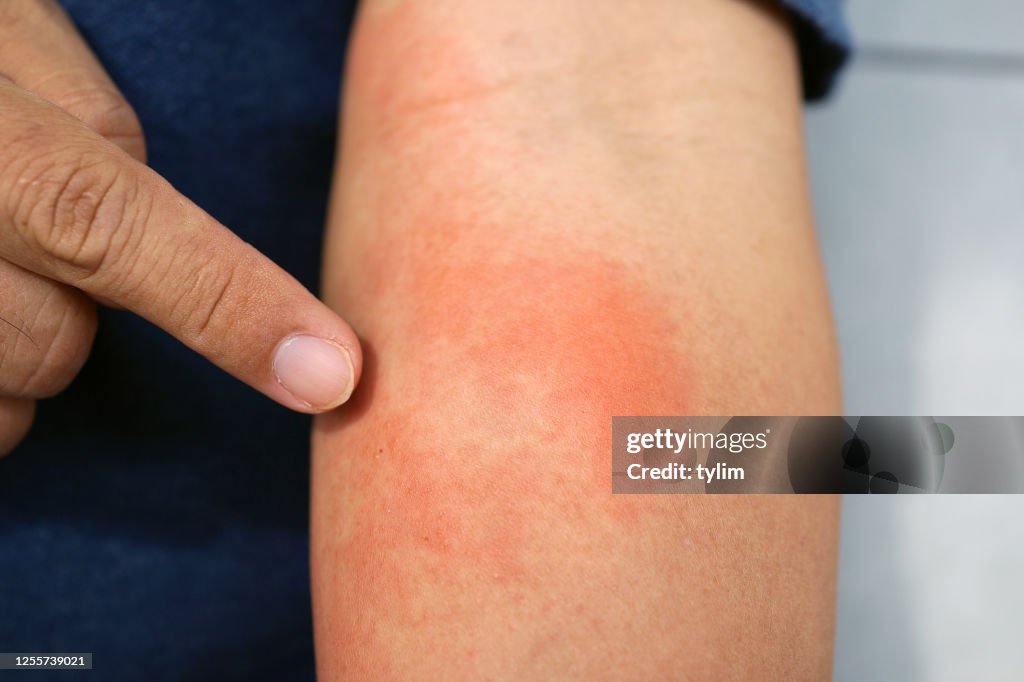 Pustular Rash Forearm Allergic Rash Dermatitis Eczema Skin On Forearm Of Patient High-Res ...