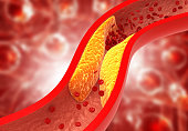 Clogged arteries, Cholesterol plaque in artery