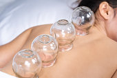 woman receiving cupping treatment on back