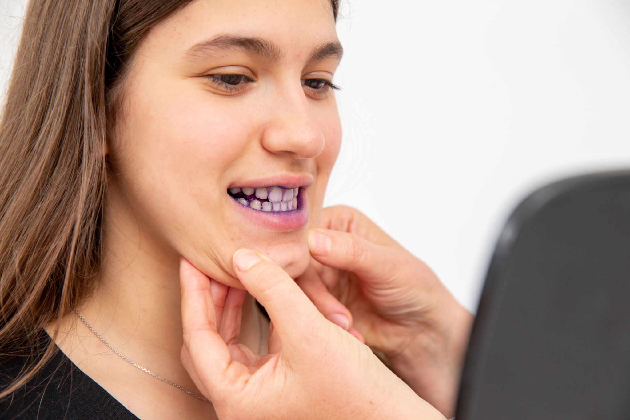 lingual braces