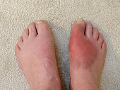 Gout in foot
