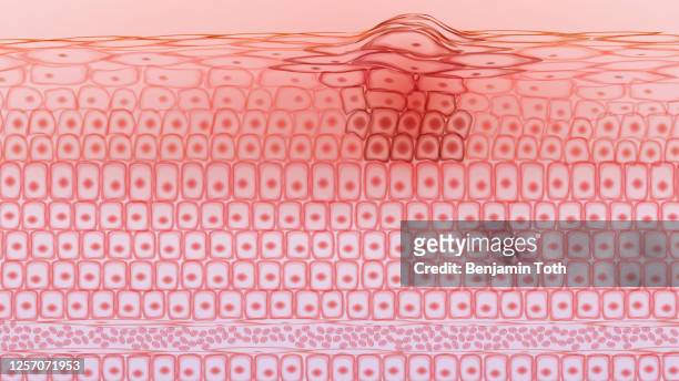 skin tissue cancerous cells, melanoma - human skin cross section stock illustrations