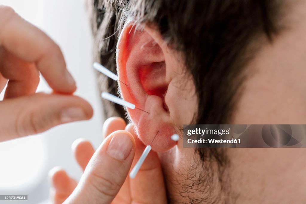 Acupuncture Example Chinese Acupuncture Needles