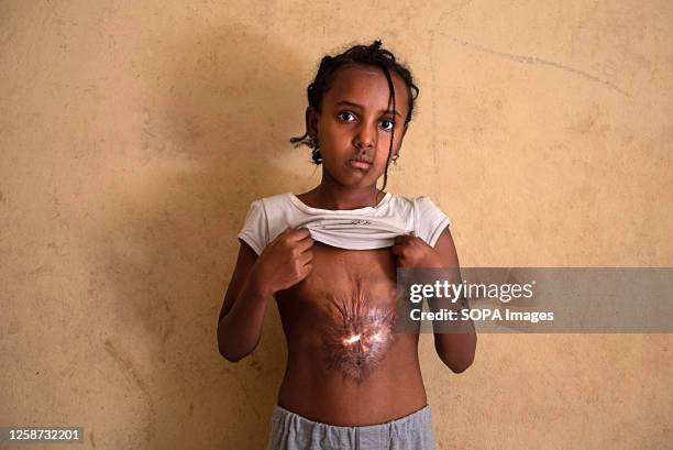 Girl shows a huge scar on her stomach caused by knives and boiling water caused by Eritrean soldiers as they raped her mother in Tigray. Tigray, one...