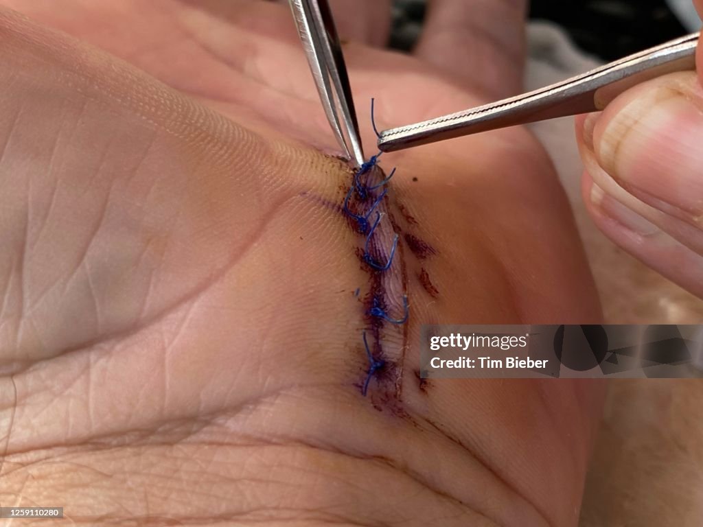 Medical suture stitches being removed at home