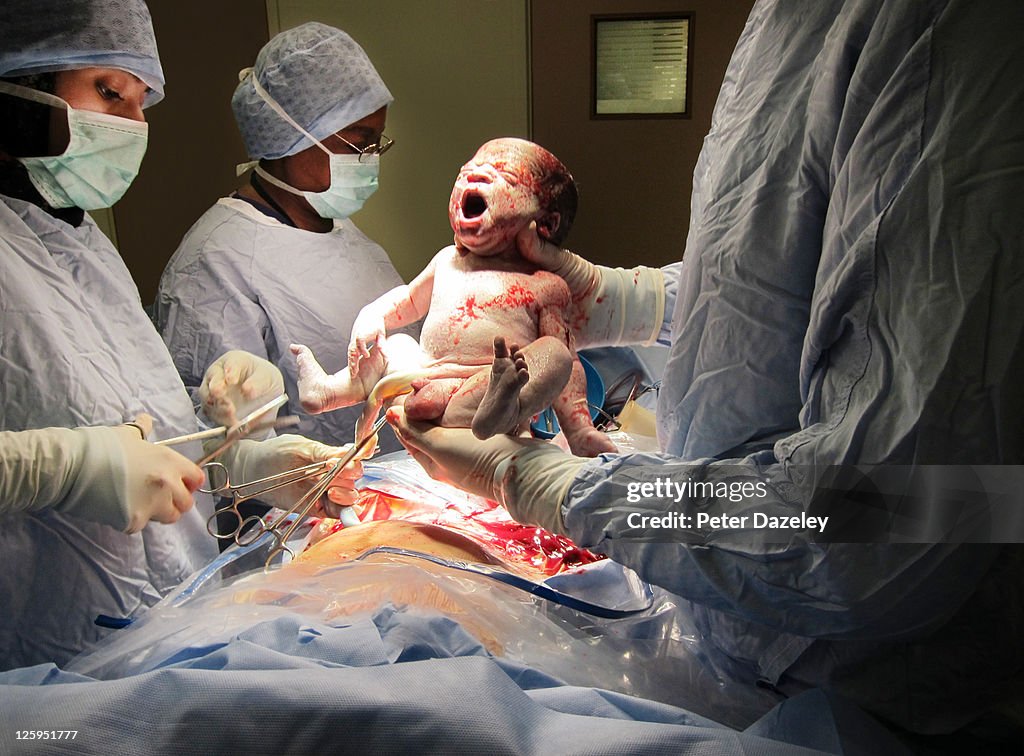 Caesarian baby's first breath