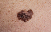 Melanoma - a malignant tumor of the skin