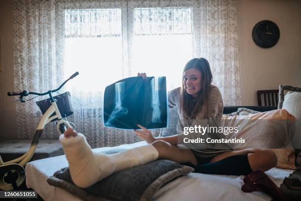 behinderte frau mit gebrochenem bein und gipsfuß zu hause - knochenbruch stock-fotos und bilder