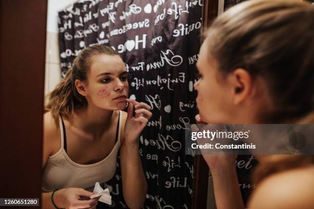 teenage problems - acnes stock pictures, royalty-free photos & images