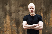 Albino African man in black t-shirt, looking at camera