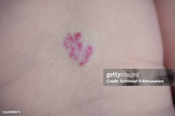 Child Birthmark Photos and Premium High Res Pictures - Getty Images
