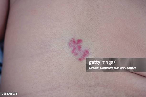 53 Red Birthmark Stock Photos, High-Res Pictures, and Images - Getty Images