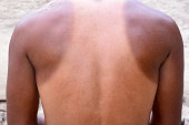 Extra sun-scorched shoulders and neck skin, The body part between the lateral upper joint of the human arm and the neck, reaction to injury or infection
