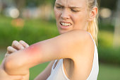 Annoyed young woman scratching her arm itching from a mosquito bite.
