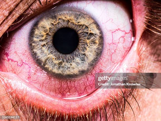 bloodshot eye - eyesight problem stock pictures, royalty-free photos & images