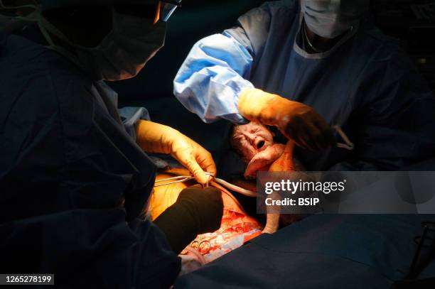 Cesarean delivery of a woman pregnant with twins. Scheduled intervention. Presence in the operating room of obstetrician gynecologist, internal...