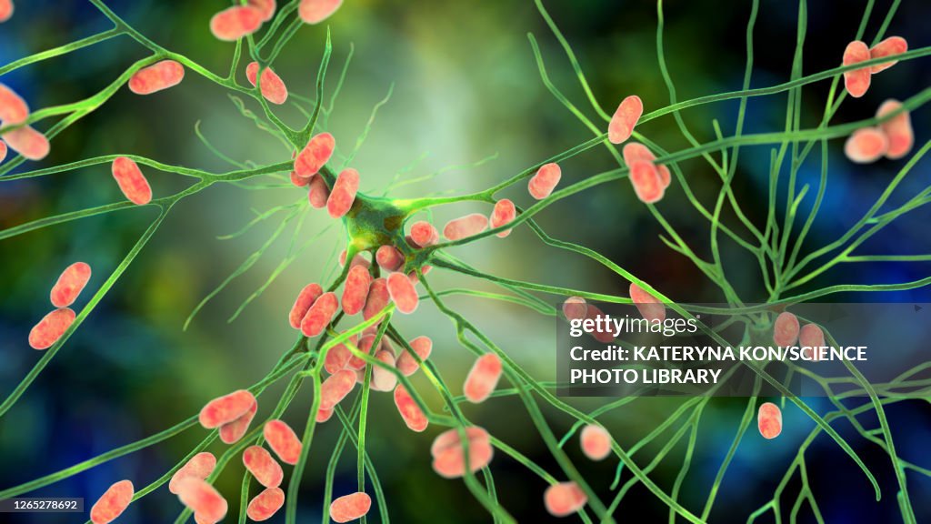 Bacterial encephalitis, illustration