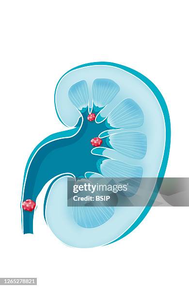 Lithiasis Kidney stone, urolithiasis, lithiasis disease. Kidney stone is a ...