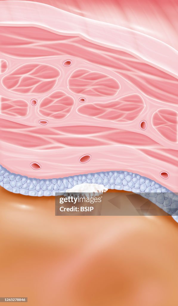 Bladder cancer