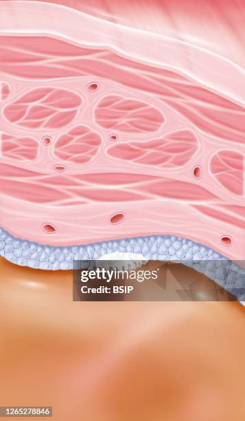 Stage 0a superficial bladder cancer. This illustration shows a zoom at the level of the bladder wall with all its structures. From bottom to top we...