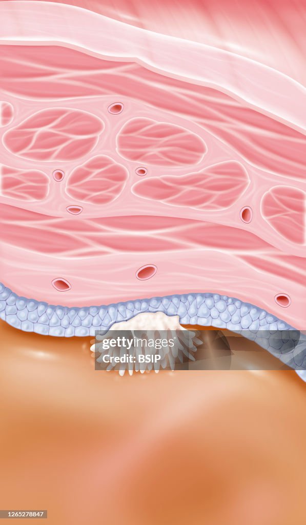 Bladder cancer