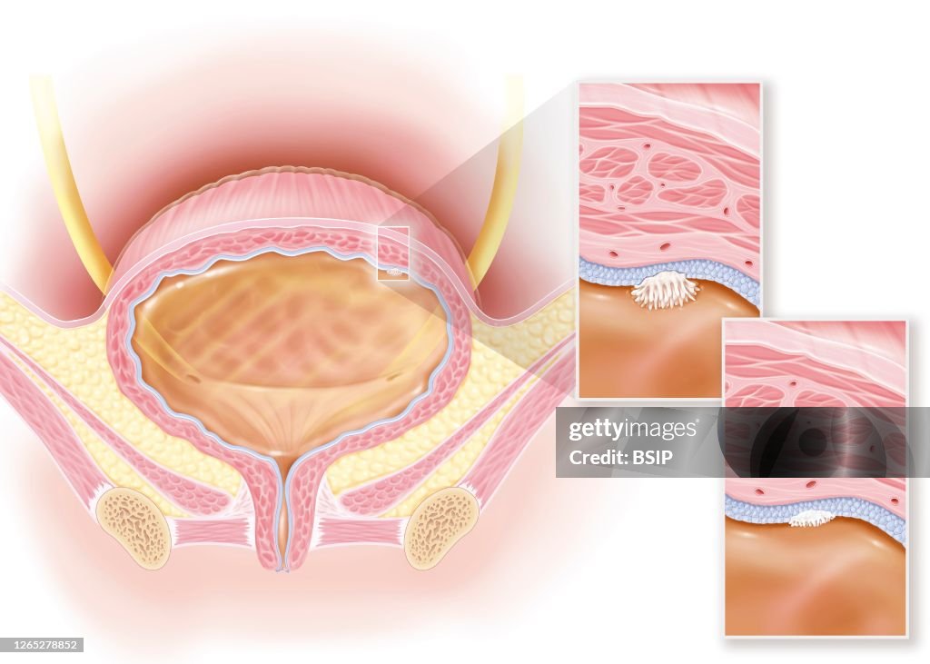 Bladder cancer