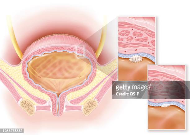 Stage 0a and 0is superficial bladder cancer, urothelial and in situ carcinoma. This illustration shows a woman's bladder with, in the upper right of...