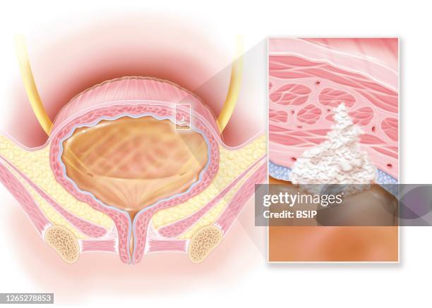 Invasive bladder cancer, stage II, muscle damage. This illustration shows a woman's bladder with a stage II invasive cancerous tumor at the top right...