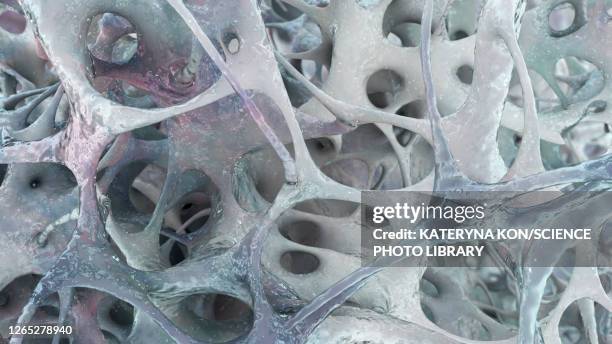 stockillustraties, clipart, cartoons en iconen met osteoporosis, illustration - osteoporose