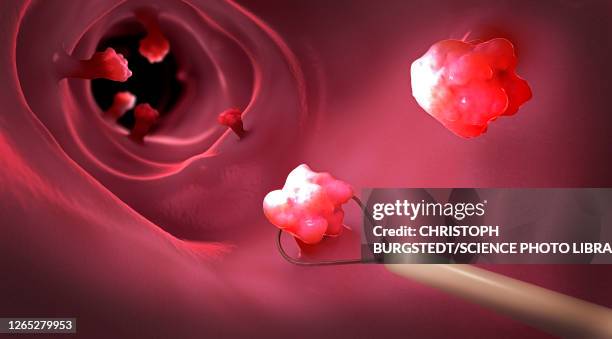 removal of a colonic polyp, illustration - biopsy stock illustrations