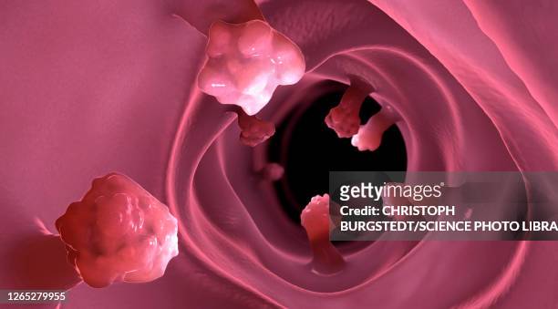 intestinal polyps, illustration - dickdarm verdauungstrakt stock-grafiken, -clipart, -cartoons und -symbole