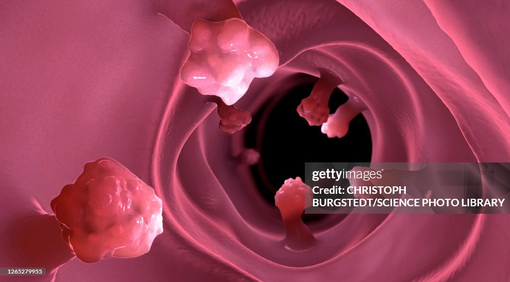 Intestinal polyps, illustration