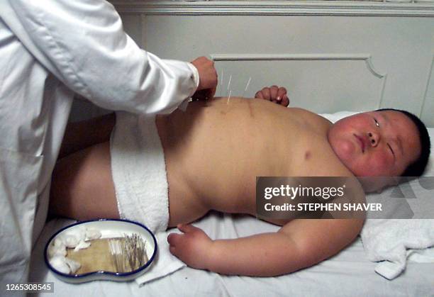 Nurse specializing in acupuncture sticks long sharp needles into the stomach of a young boy as a form of treatment for severe obesity 02 April 1999...