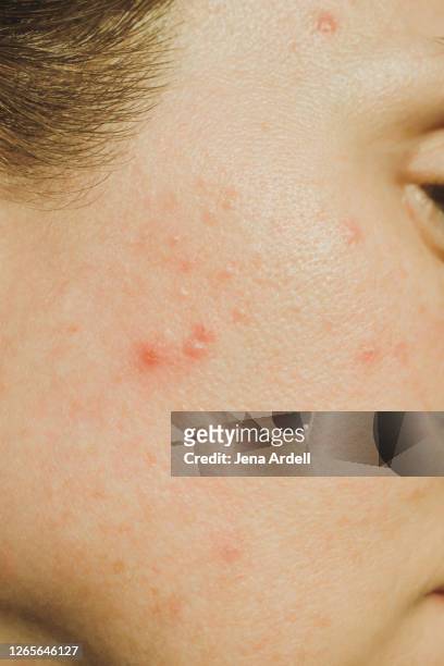 adult acne pimples on skin closeup with zits - akne stock-fotos und bilder