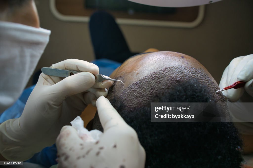 Haartransplantation