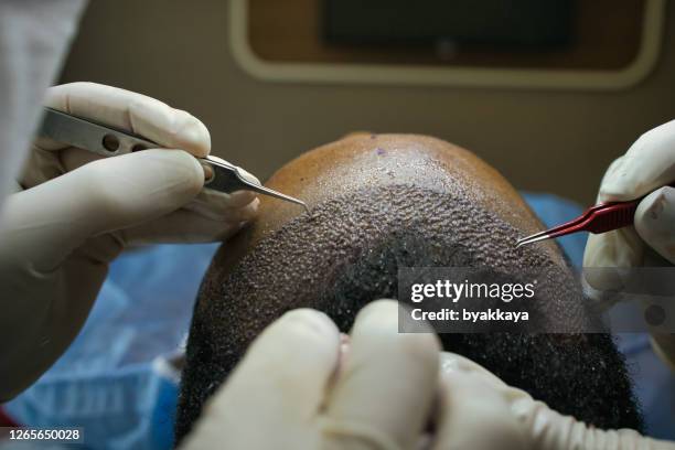 hair transplant - transplant surgery stock pictures, royalty-free photos & images