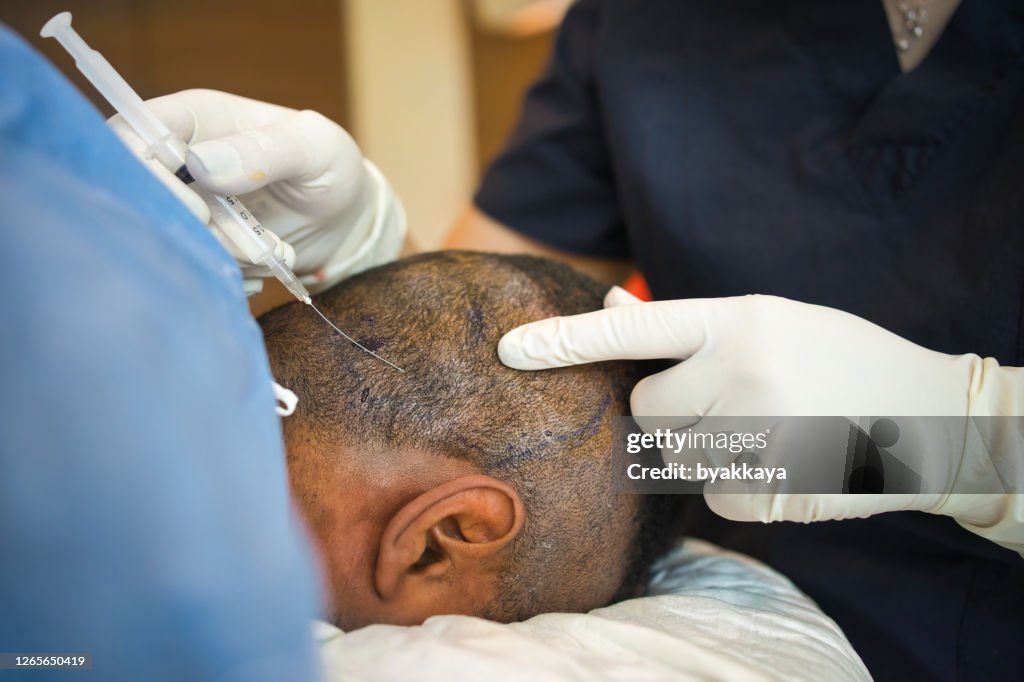 Haartransplantation