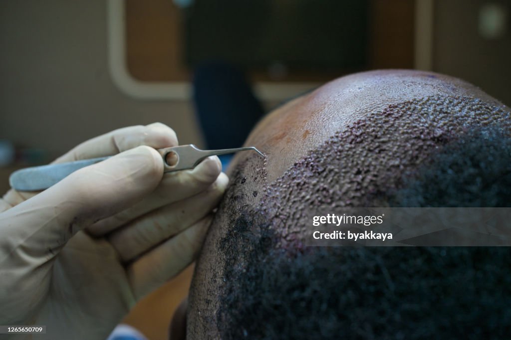 Haartransplantation