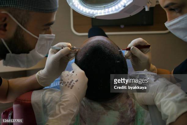haartransplantation - haartransplantation stock-fotos und bilder