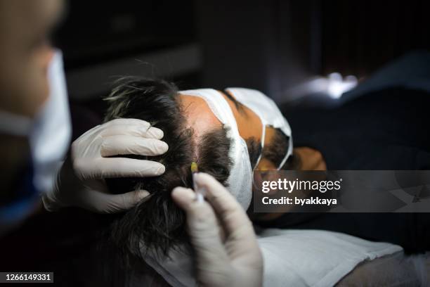 hombre con dificultad para perder el cabello al recibir inyección en la cabeza - plasma rico en plaquetas fotografías e imágenes de stock