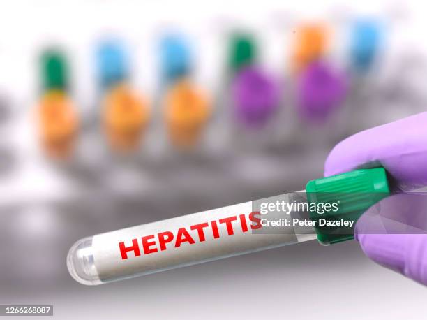 test tube containing hepatitis vaccine - hepatite imagens e fotografias de stock