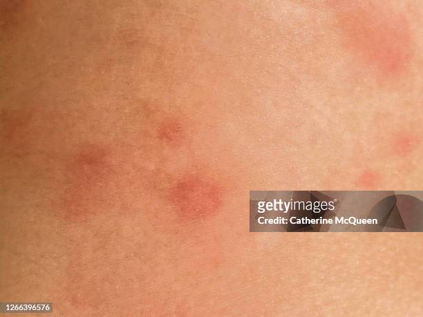 swollen & red mosquito bites on unrecognizable female’s leg - lymekrankheit stock-fotos und bilder